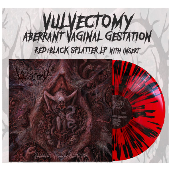 VULVECTOMY - ABERRANT VAGINAL GESTATION LP
